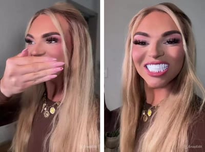 Модель потратила 20 000 долларов на виниры и рассказала о насмешках над ее новыми зубами