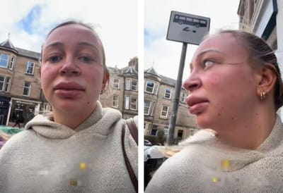 «Вот в каком виде я забирала ребёнка из сада»: женщина показала губы после удаления филлеров, чем рассмешила многих  