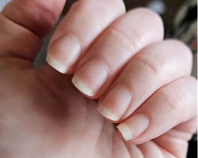 Какие изменения на ногтях могут сигнализировать о проблемах с сердцем или печенью