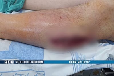 огнестрельное ранение