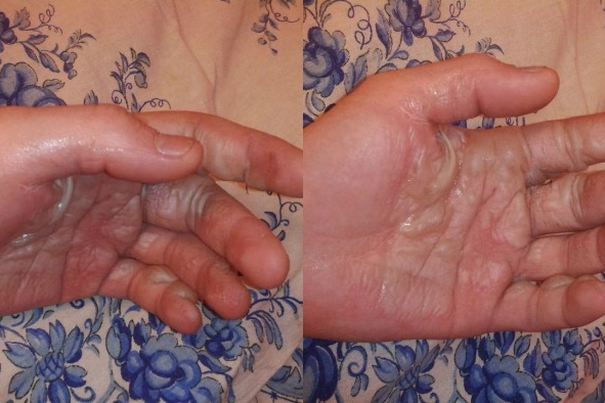 Пиротехника покалечила людей в Гродно, Сморгони и Марьиной Горке