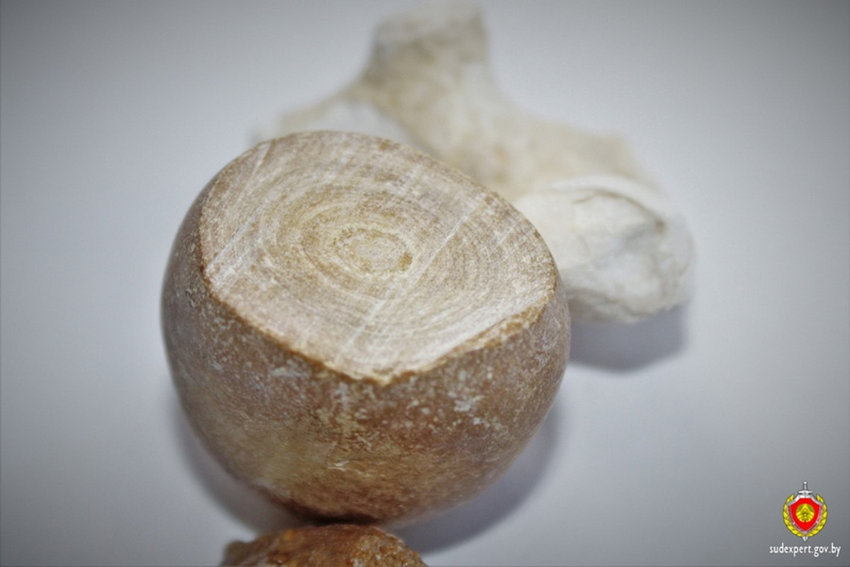 Почечный камень внушительных размеров извлекли у жителя Гродно