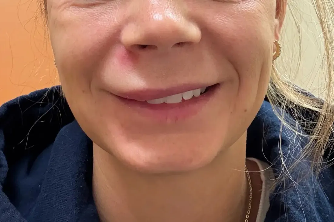 «Выдавливание прыща чуть не стоило мне жизни – я затронула треугольник смерти