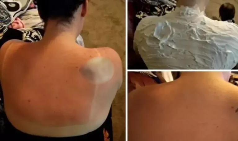 Обгоревшая на пляже женщина нашла неожиданное спасение — и это вовсе не йогурт!